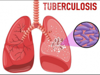 Туберкулез - қауіпті дерт